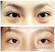 活性炭面膜的作用和功效