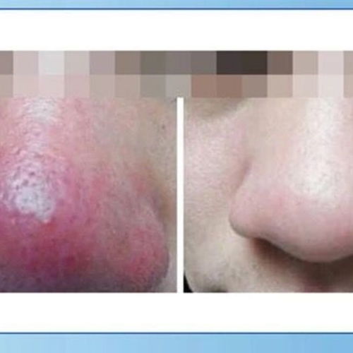 鼻子发红用活性炭好不